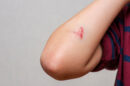 schnittwunde am arm